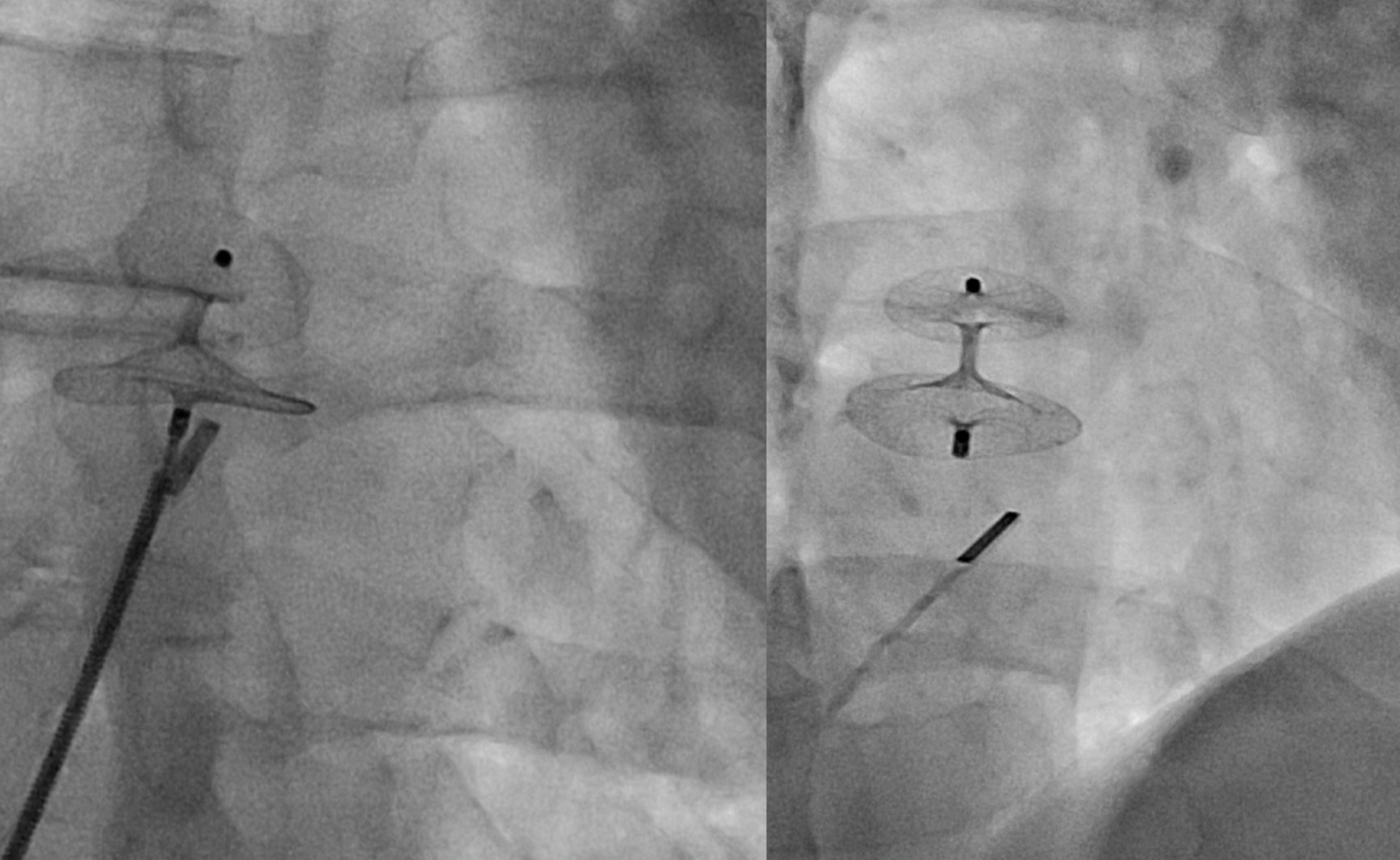 Imagens reais de raio-X (fluoroscopia) durante o implante do dispositivo oclusor de CIA/FOP em sala de hemodinâmica