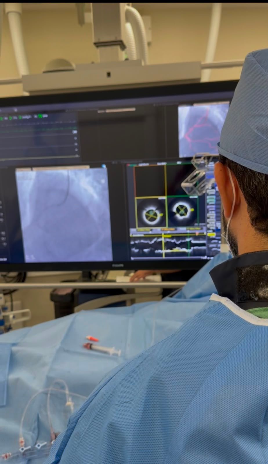 Imagem real de OCT durante angioplastia coronária realizada pelo Dr. Murilo Camargo em sala de hemodinâmica