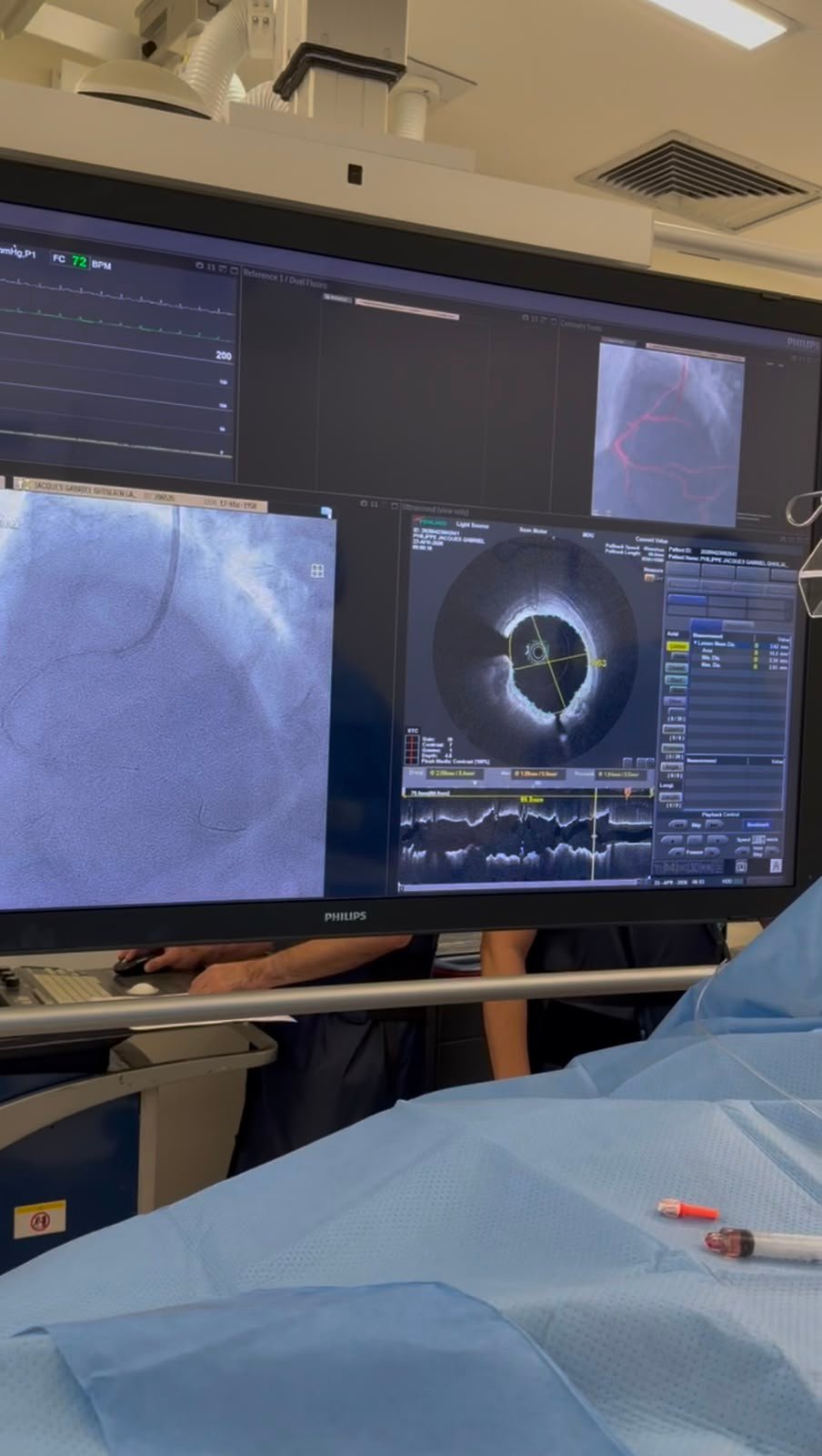 Tela de hemodinâmica com angiografia coronária e OCT lado a lado durante procedimento de angioplastia complexa