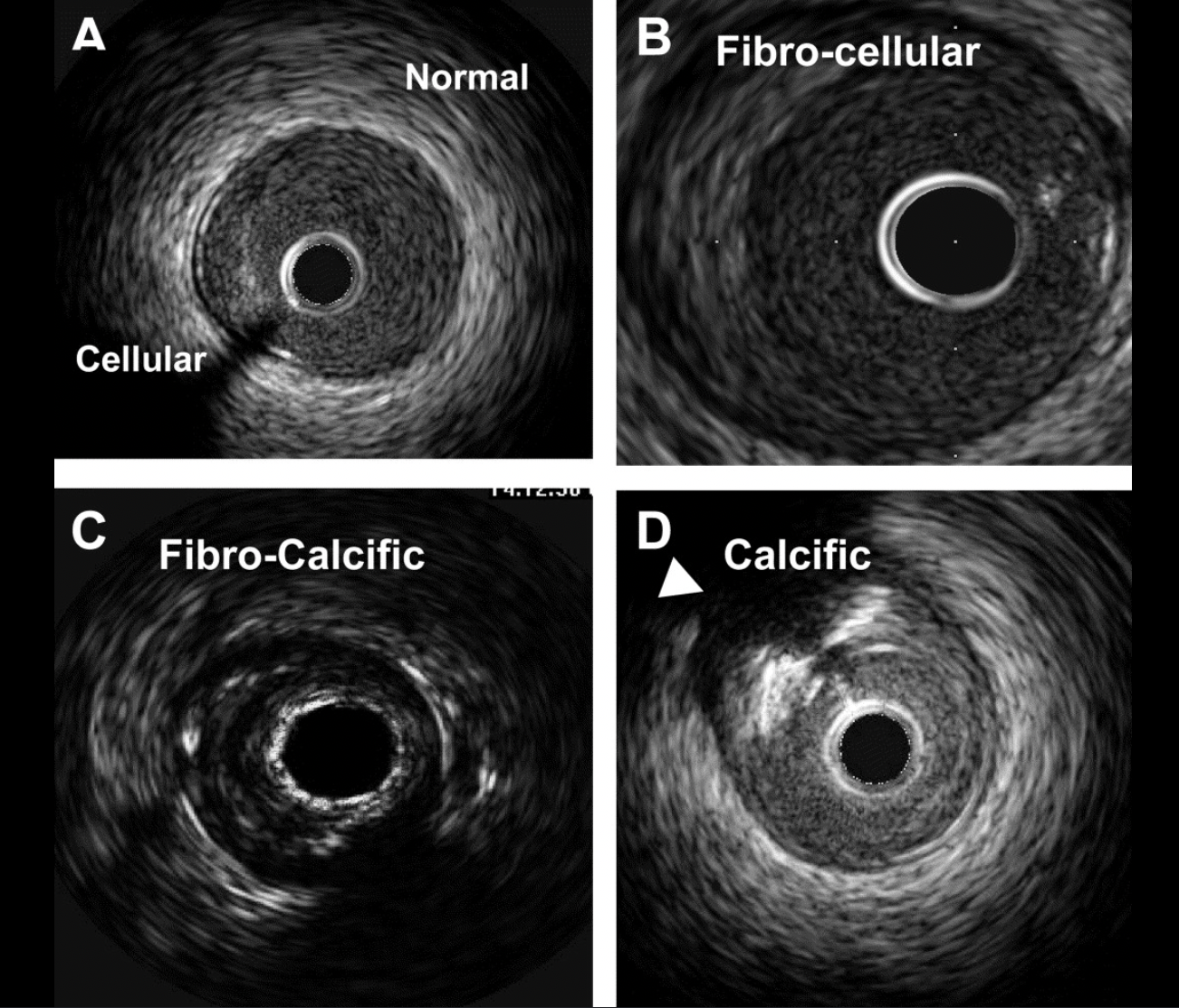 Imagens de ultrassom intravascular (IVUS) mostrando diferentes composições de placa: normal/celular, fibrocelular, fibrocalcificada e calcificada