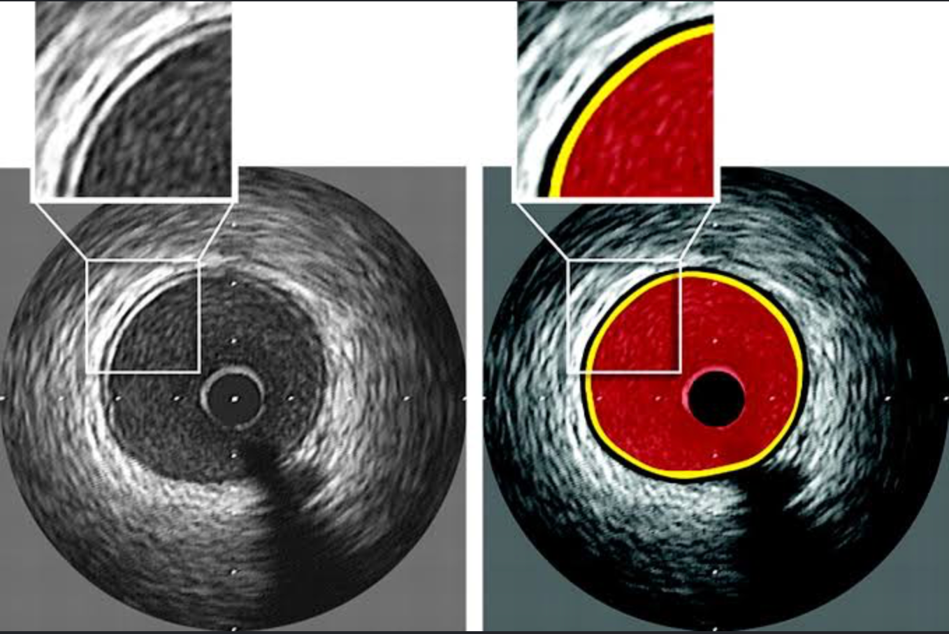 Imagem de ultrassom intravascular (IVUS) com medição da área de placa e do lúmen da artéria, destacada em vermelho