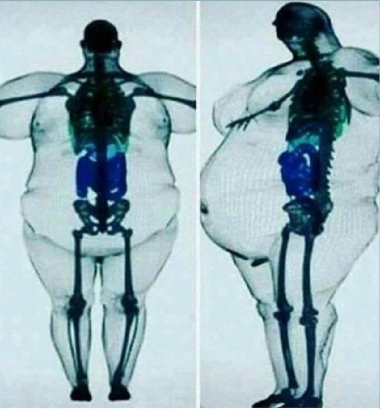 Imagem de exame de composição corporal (DEXA) comparando dois pacientes, com a gordura visceral destacada em azul ao redor dos órgãos abdominais